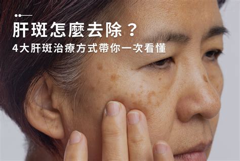 長斑位置|曬斑、肝斑、長斑怎麼辦？有效淡化斑點5個方法：淡。